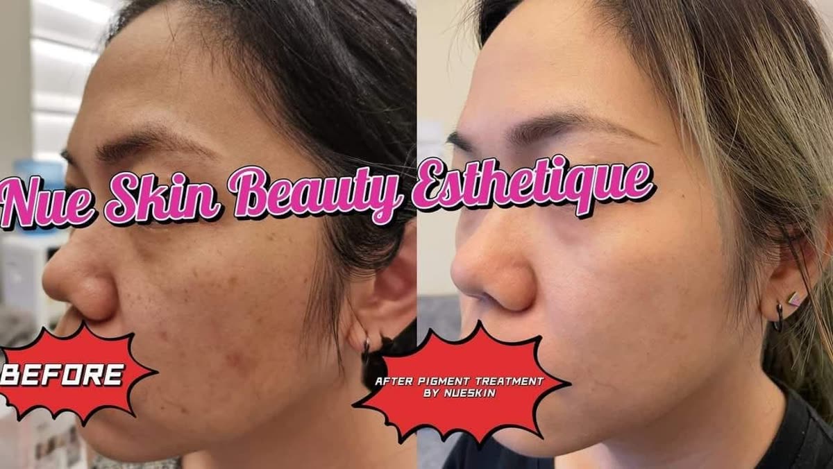 Client treatment result before and after — Nue Skin Beauty Esthetique