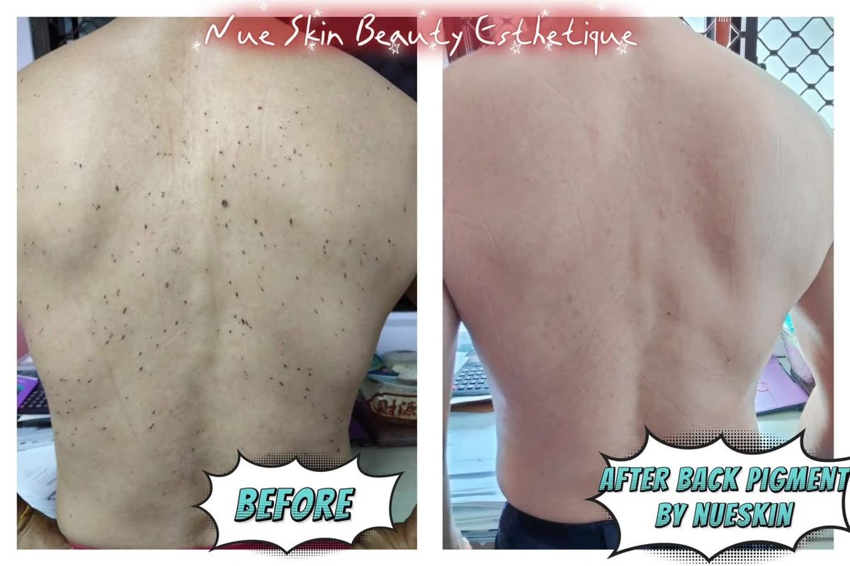 Client treatment result before and after — Nue Skin Beauty Esthetique