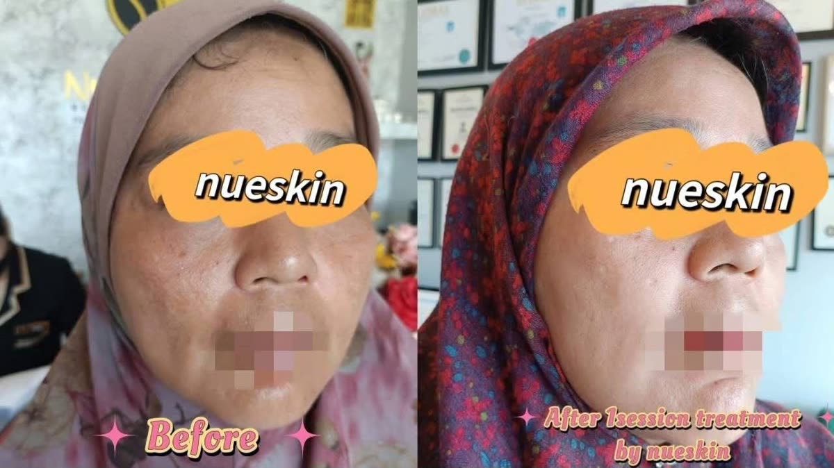 Client treatment result before and after — Nue Skin Beauty Esthetique