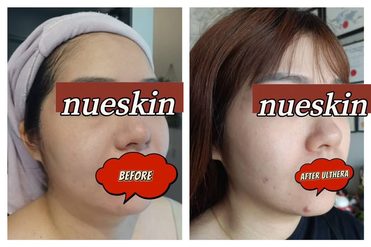 Client treatment result before and after — Nue Skin Beauty Esthetique