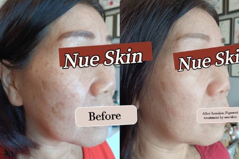Client treatment result before and after — Nue Skin Beauty Esthetique