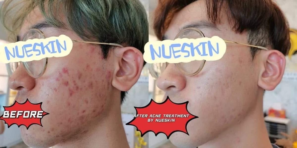 Client treatment result before and after — Nue Skin Beauty Esthetique