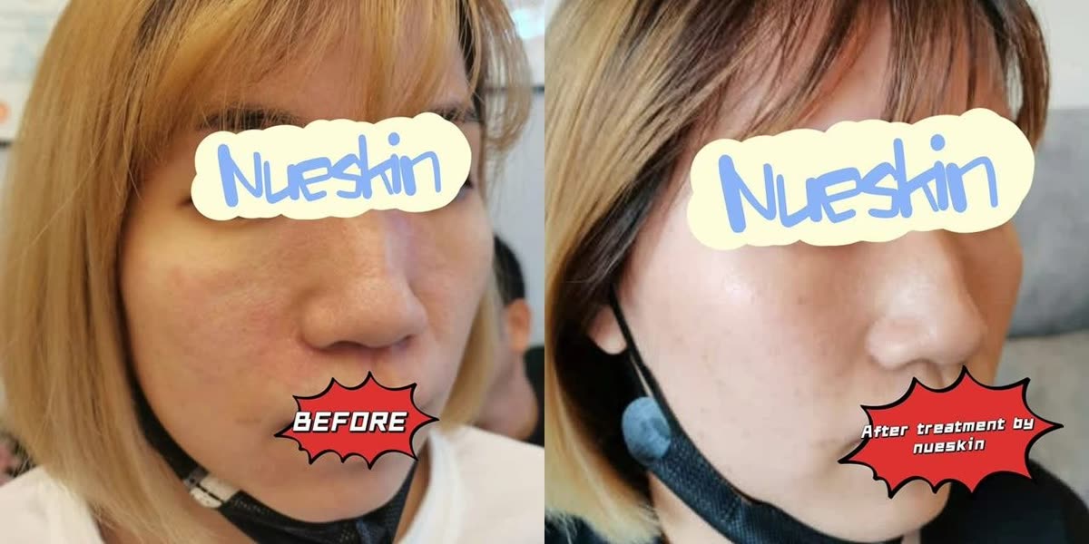 Client treatment result before and after — Nue Skin Beauty Esthetique