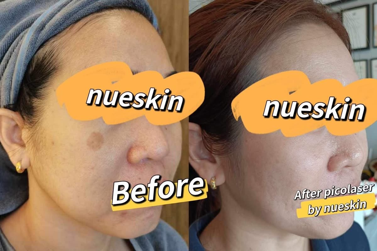 Client treatment result before and after — Nue Skin Beauty Esthetique