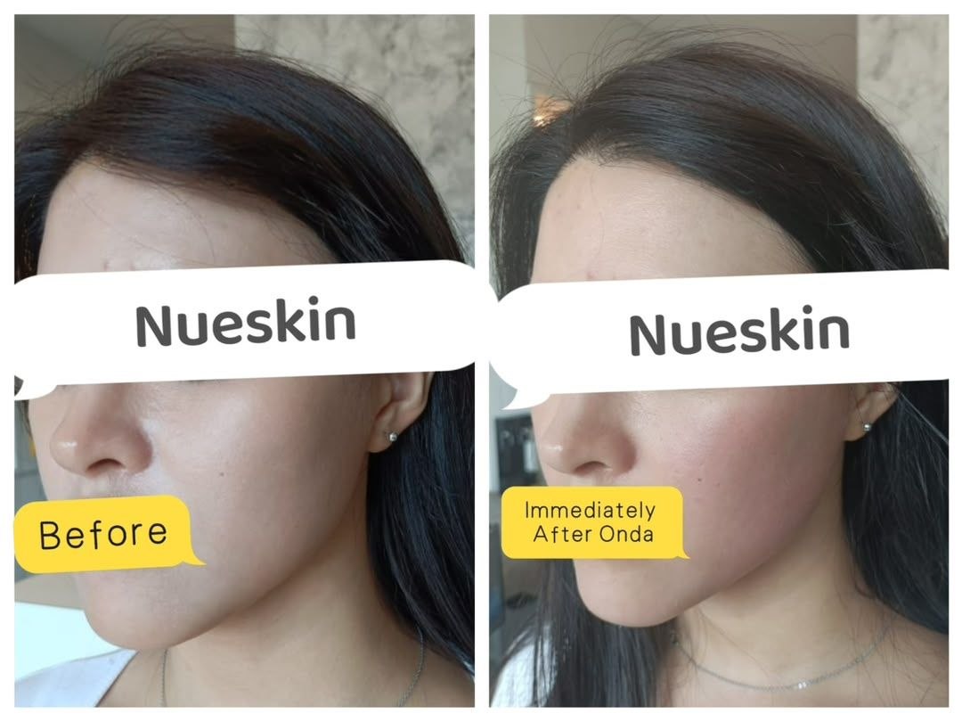 Onda Skin Lifting before and after — Nue Skin Beauty Esthetique