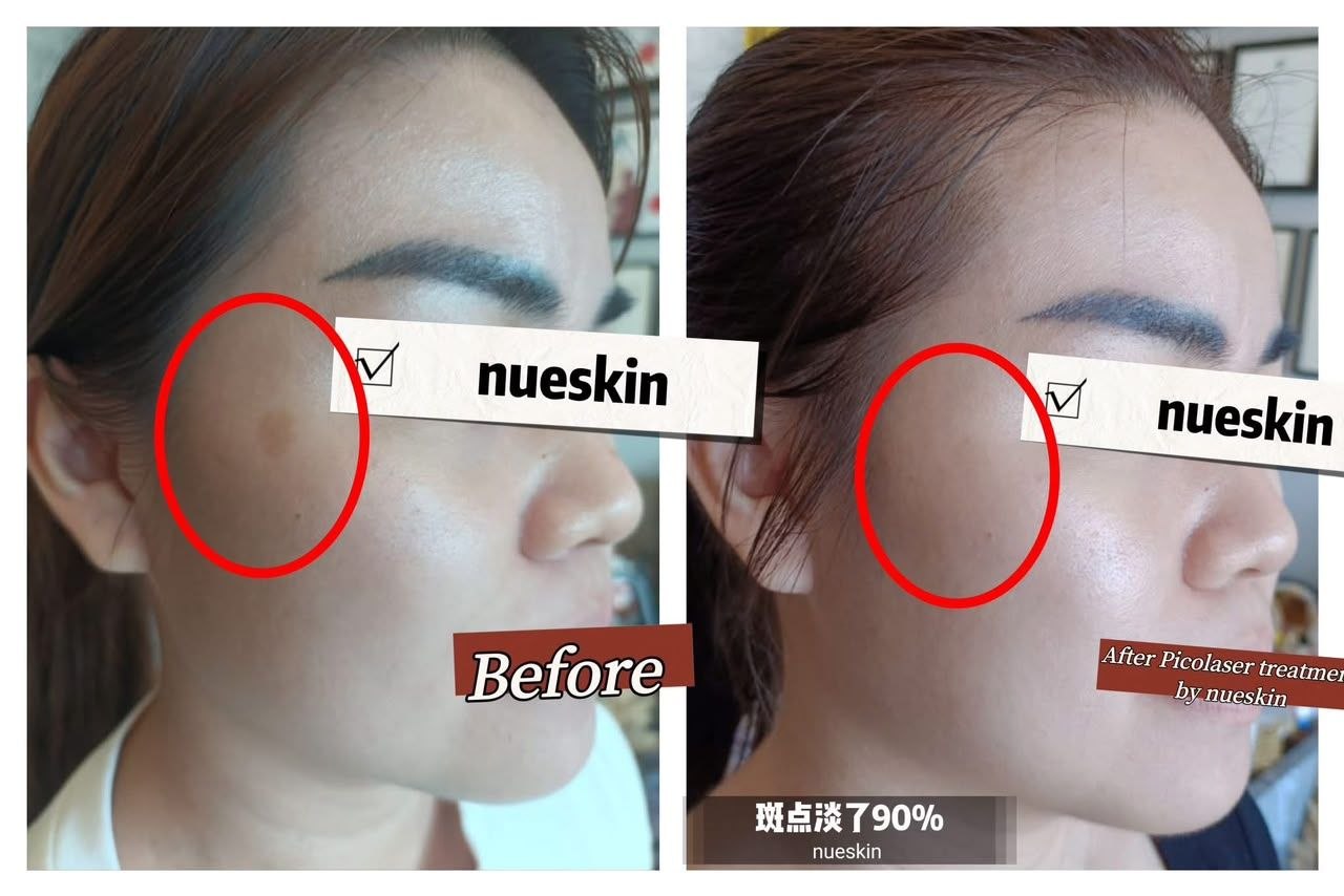 Picolaser Pigmentation Treatment before and after — Nue Skin Beauty Esthetique