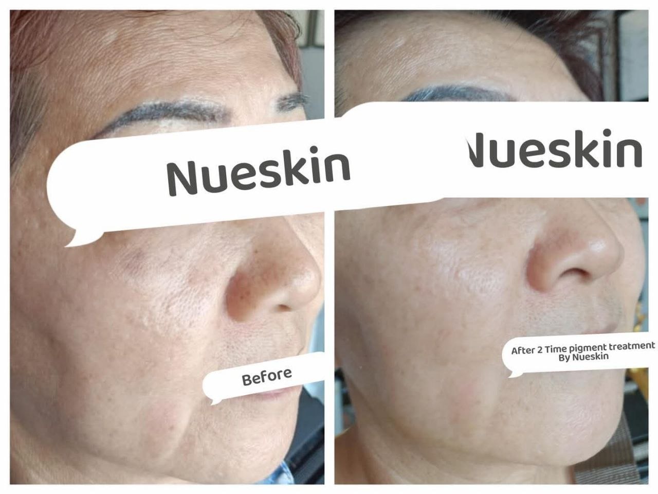 Pigment Treatment before and after — Nue Skin Beauty Esthetique