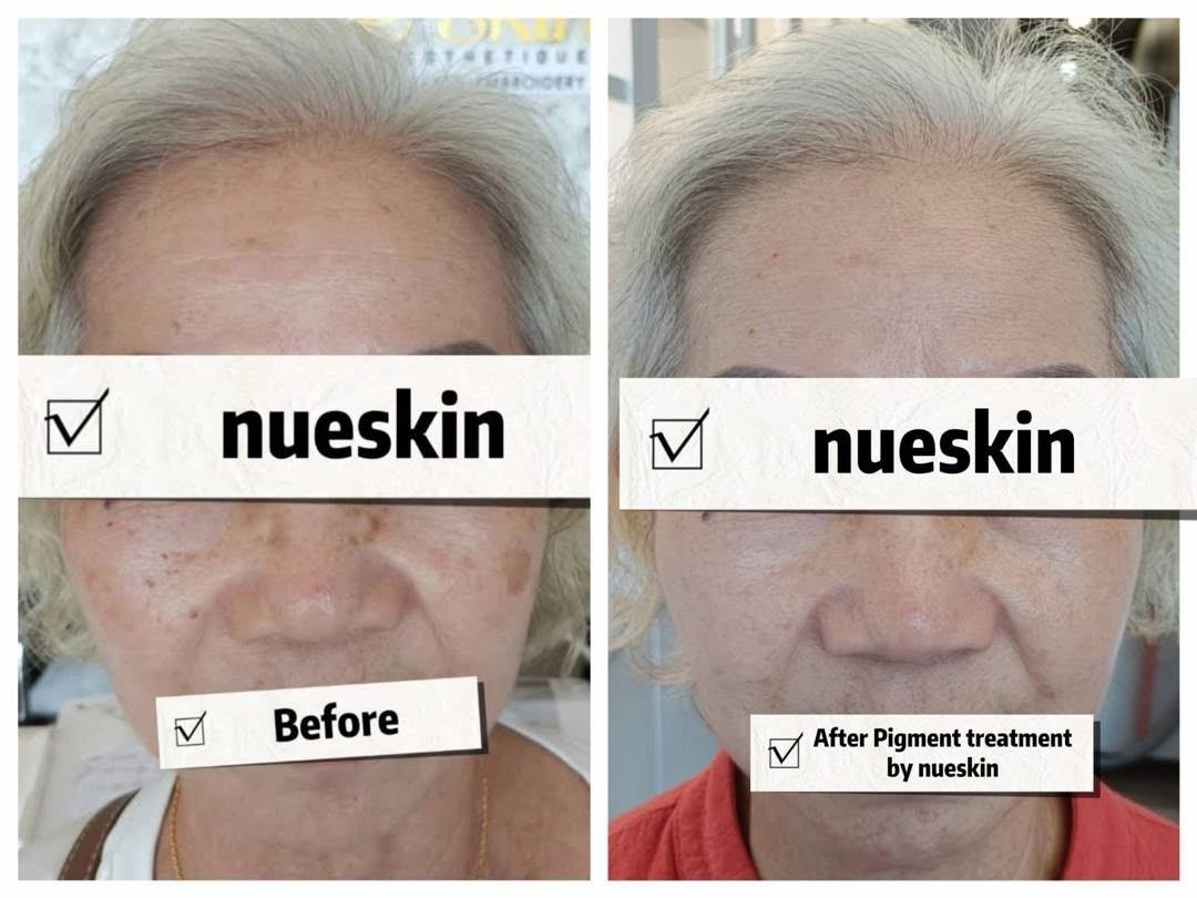 Pigment Treatment before and after — Nue Skin Beauty Esthetique