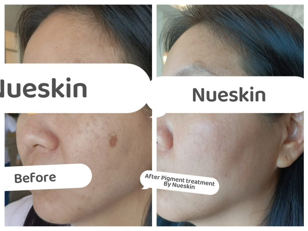 Pigment Treatment before and after — Nue Skin Beauty Esthetique
