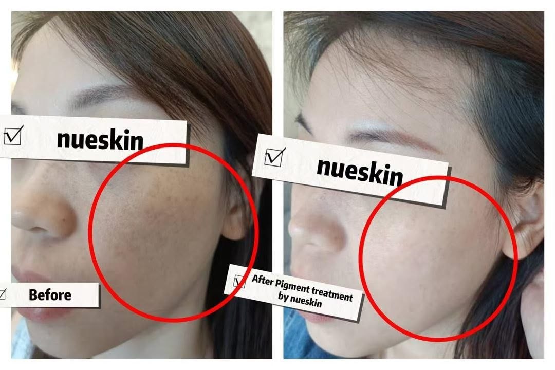 Pigment Treatment before and after — Nue Skin Beauty Esthetique