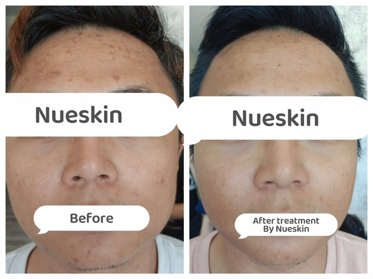 Pigment Treatment before and after — Nue Skin Beauty Esthetique