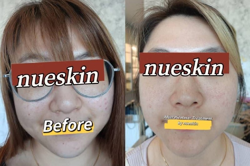 Pigment Treatment before and after — Nue Skin Beauty Esthetique