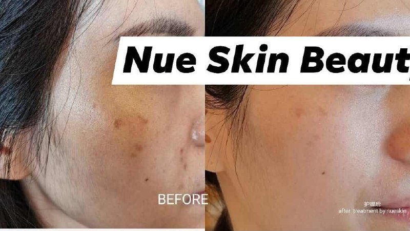 Pigment Treatment before and after — Nue Skin Beauty Esthetique
