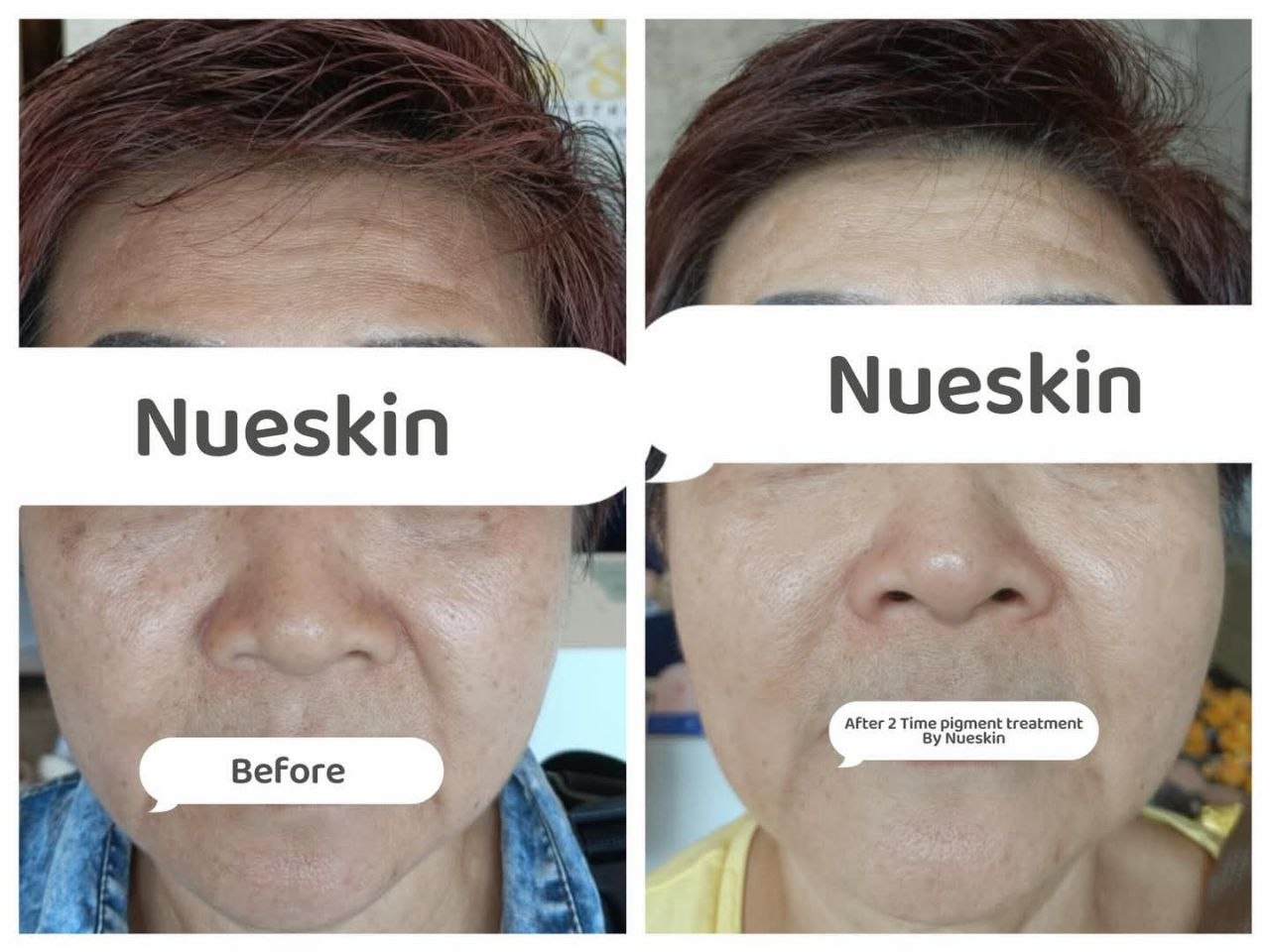 Pigment Treatment before and after — Nue Skin Beauty Esthetique