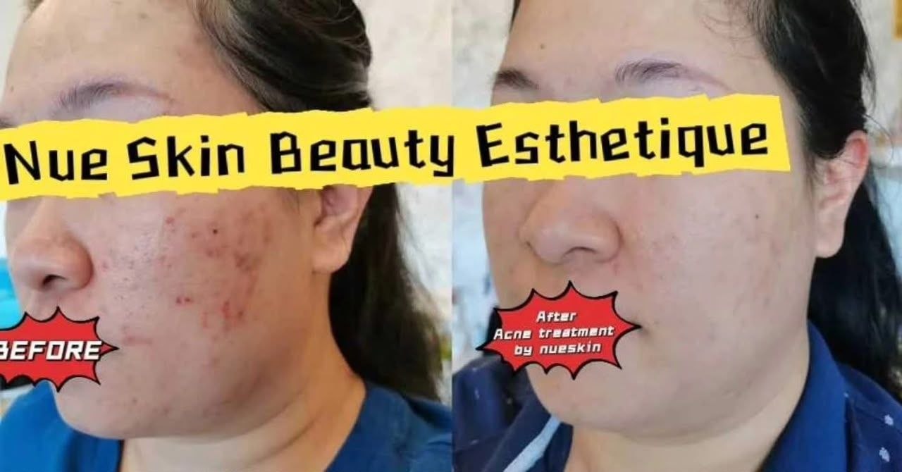 Pigment Treatment before and after — Nue Skin Beauty Esthetique