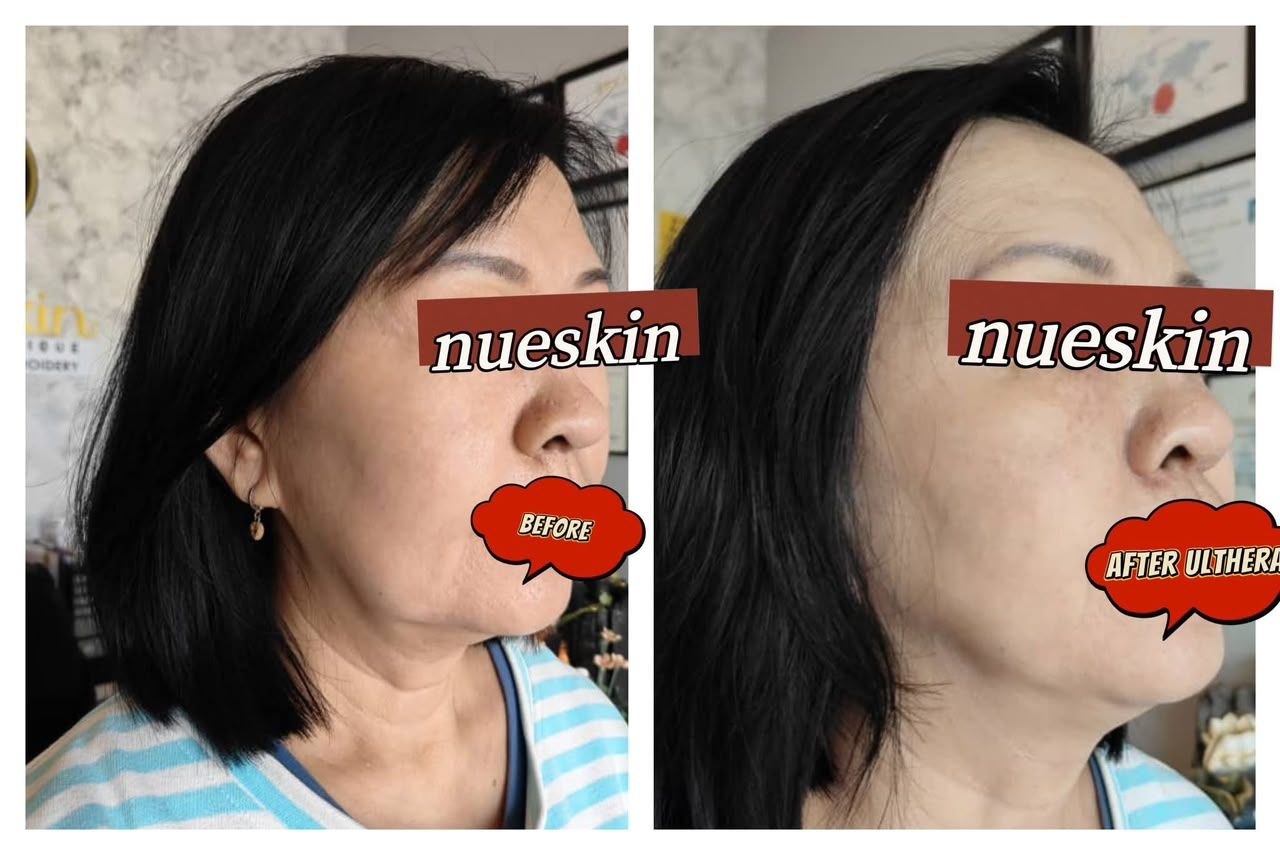 Pigment Treatment before and after — Nue Skin Beauty Esthetique