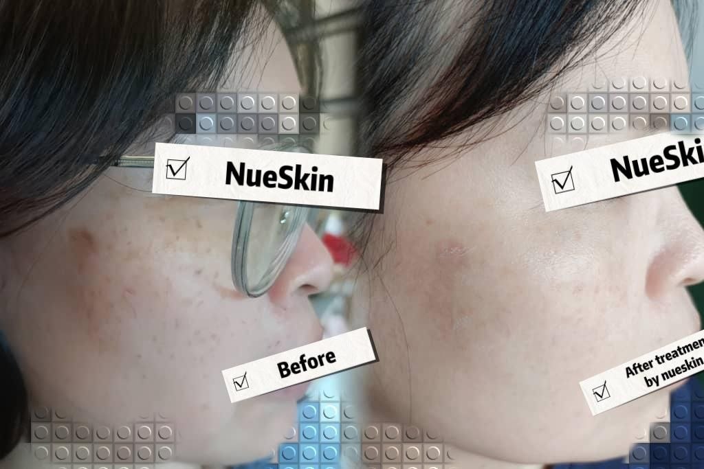 Pigment Treatment before and after — Nue Skin Beauty Esthetique