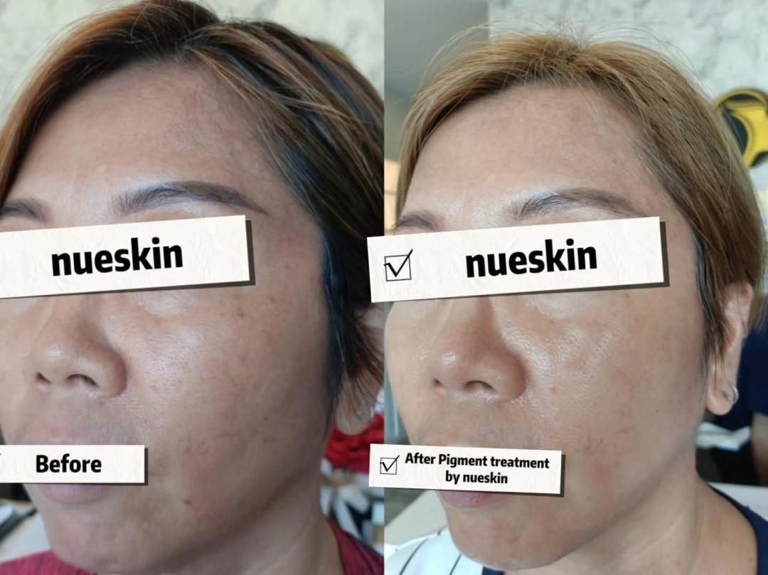 Pigment Treatment before and after — Nue Skin Beauty Esthetique