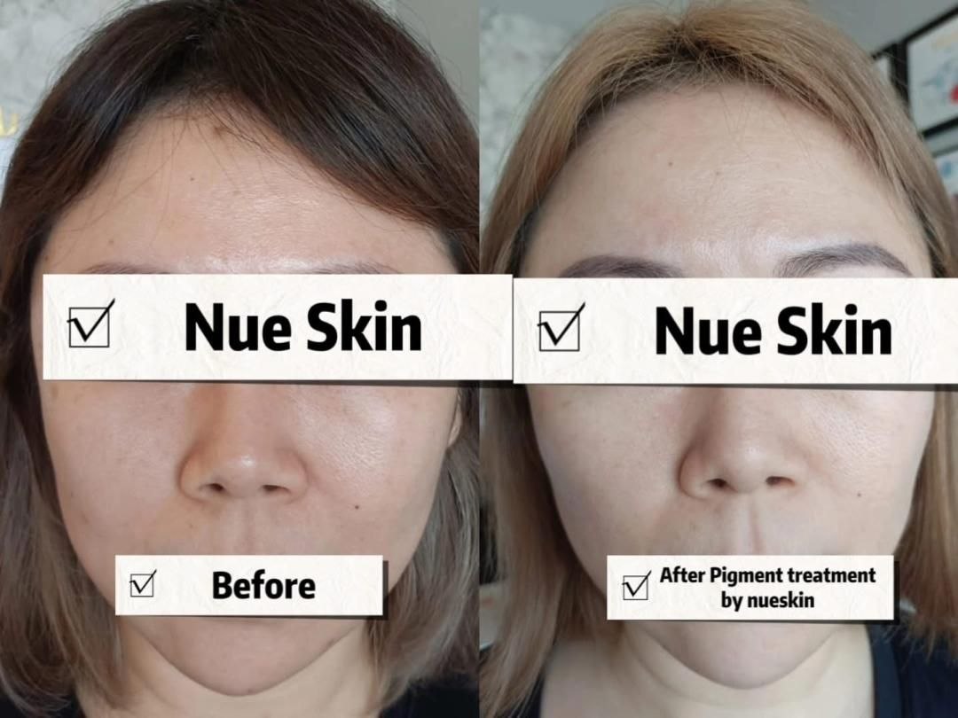 Pigment Treatment before and after — Nue Skin Beauty Esthetique