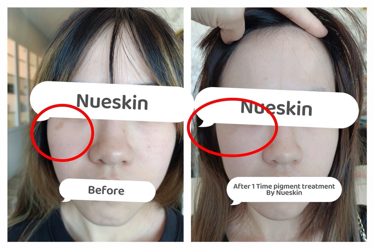 Pigmentation Treatment before and after — Nue Skin Beauty Esthetique