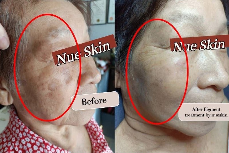 Pigmentation Treatment before and after — Nue Skin Beauty Esthetique