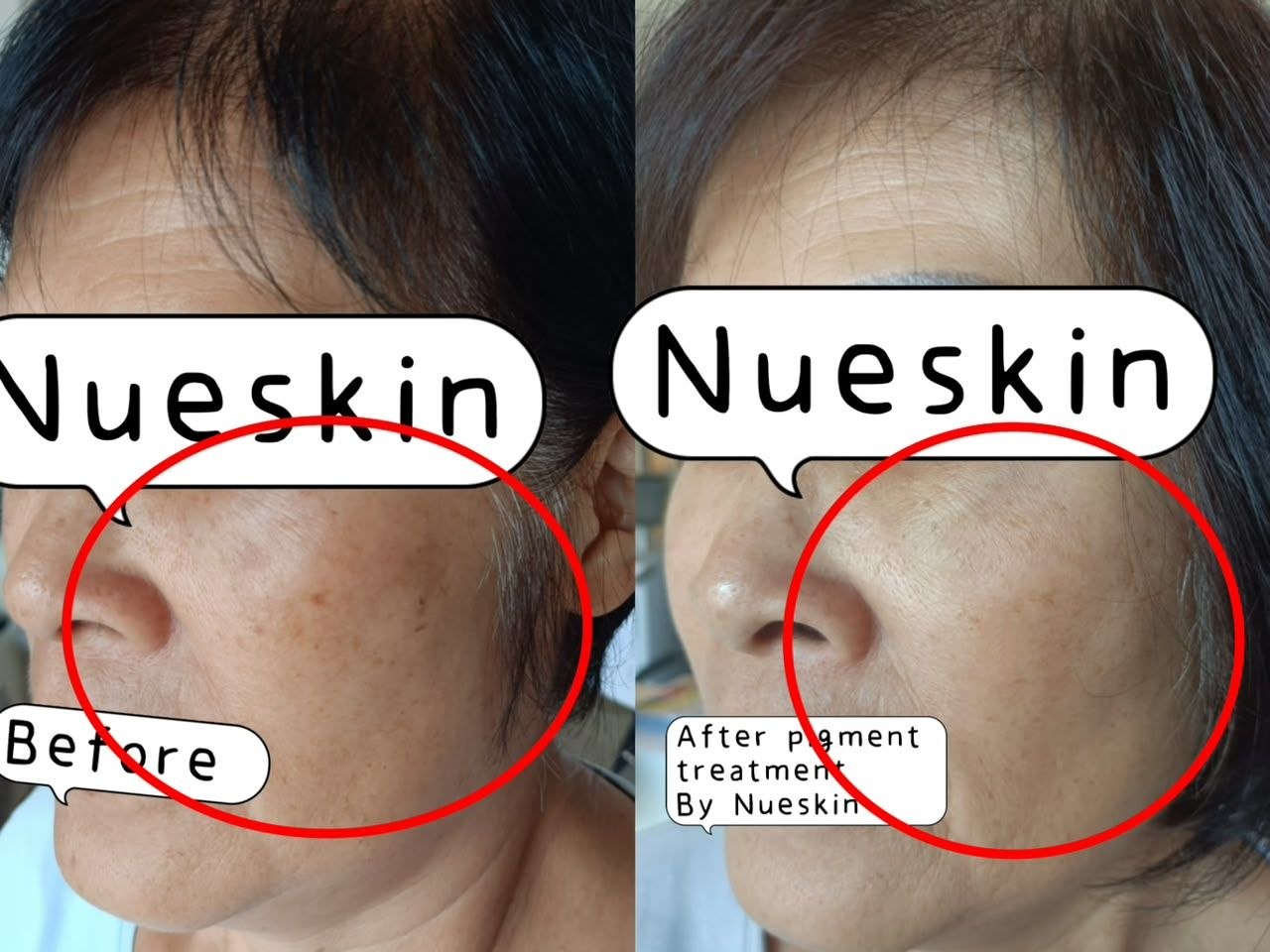 Pigmentation Treatment before and after — Nue Skin Beauty Esthetique