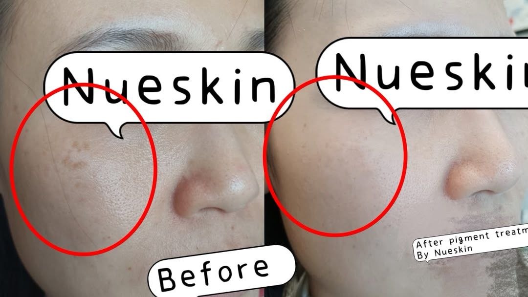 Pigment Treatment before and after — Nue Skin Beauty Esthetique