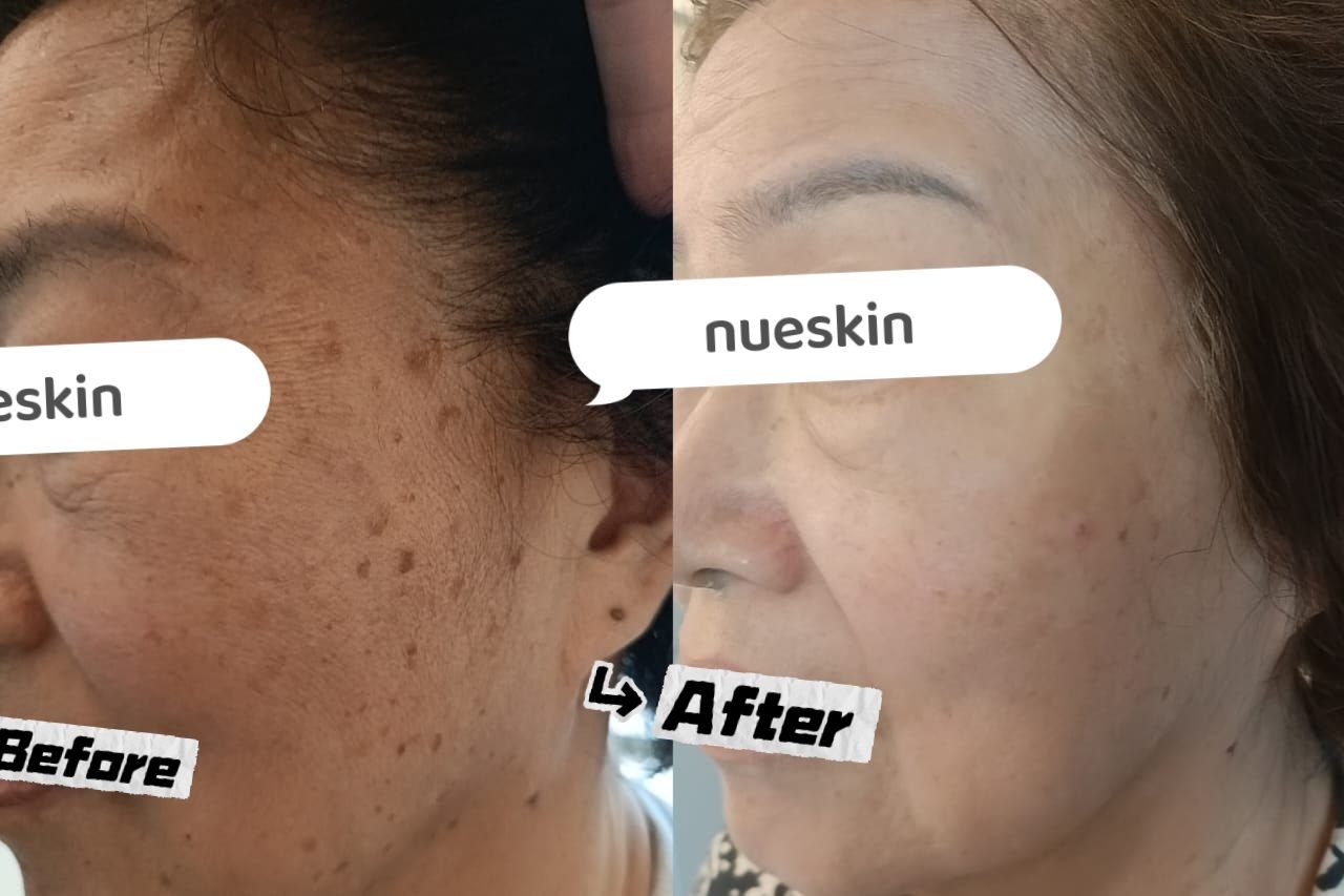 Age spot and freckle pigmentation treatment before and after — Nue Skin Beauty Esthetique