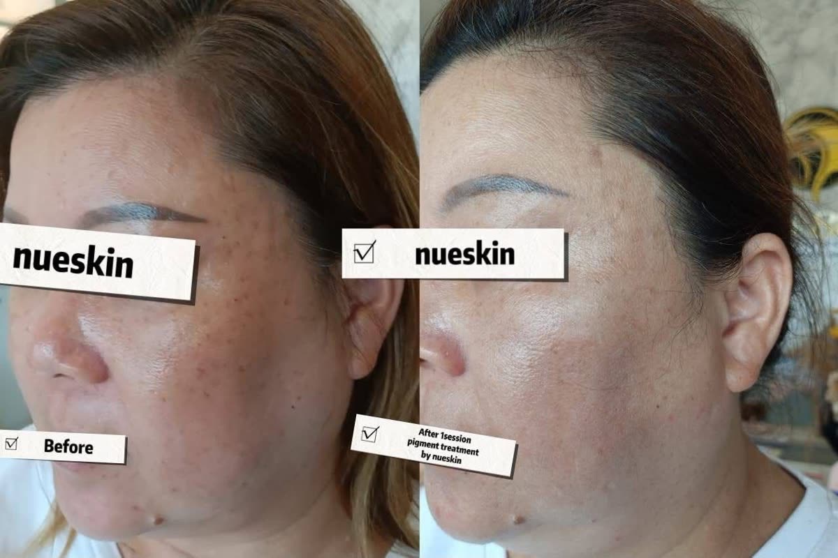 Pigment treatment forehead and nose bridge before and after — Nue Skin Beauty Esthetique