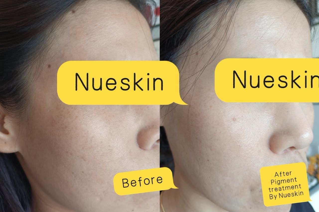 Cheek freckles and pigmentation spot removal before and after — Nue Skin Beauty Esthetique