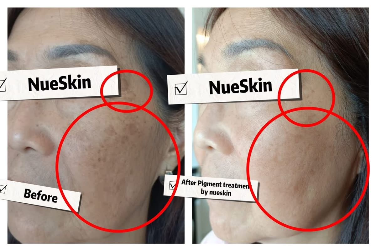 Cheek pigmentation and melasma treatment before and after — Nue Skin Beauty Esthetique