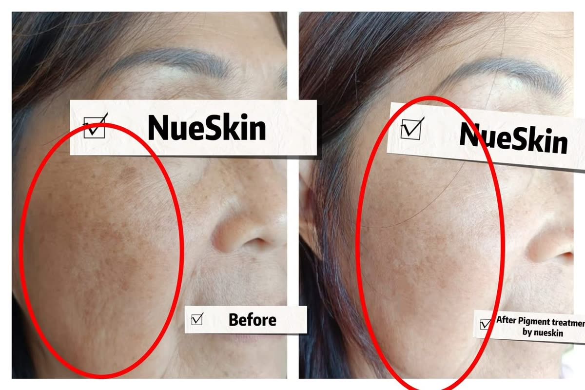 Cheek melasma pigmentation treatment before and after — Nue Skin Beauty Esthetique