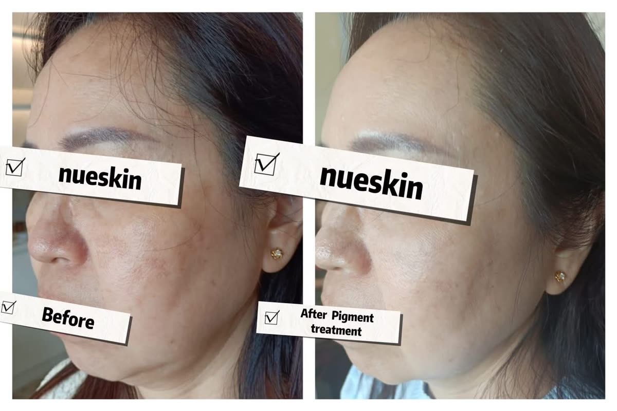 Cheek pigmentation and melasma treatment before and after — Nue Skin Beauty Esthetique