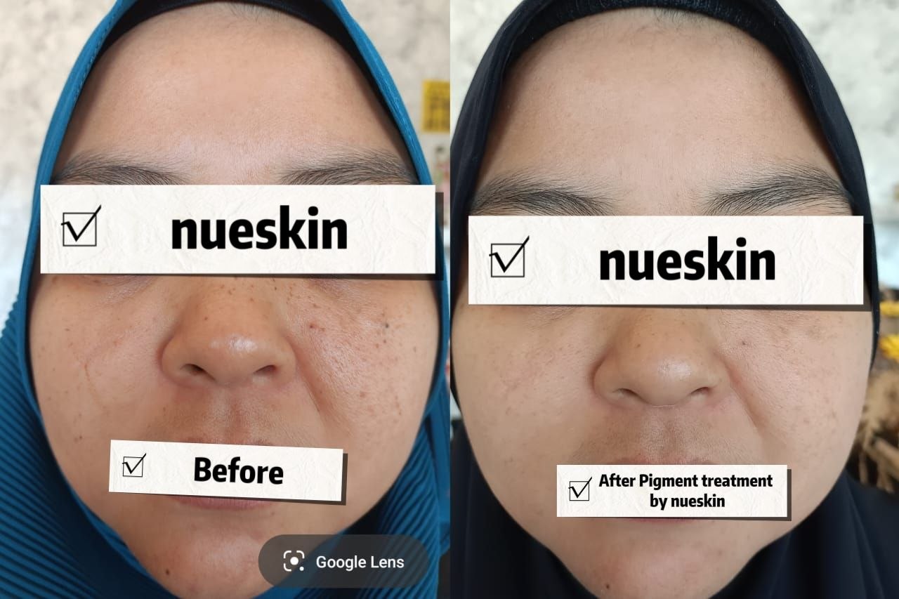 Facial pigmentation treatment result after one session — Nue Skin Beauty Esthetique