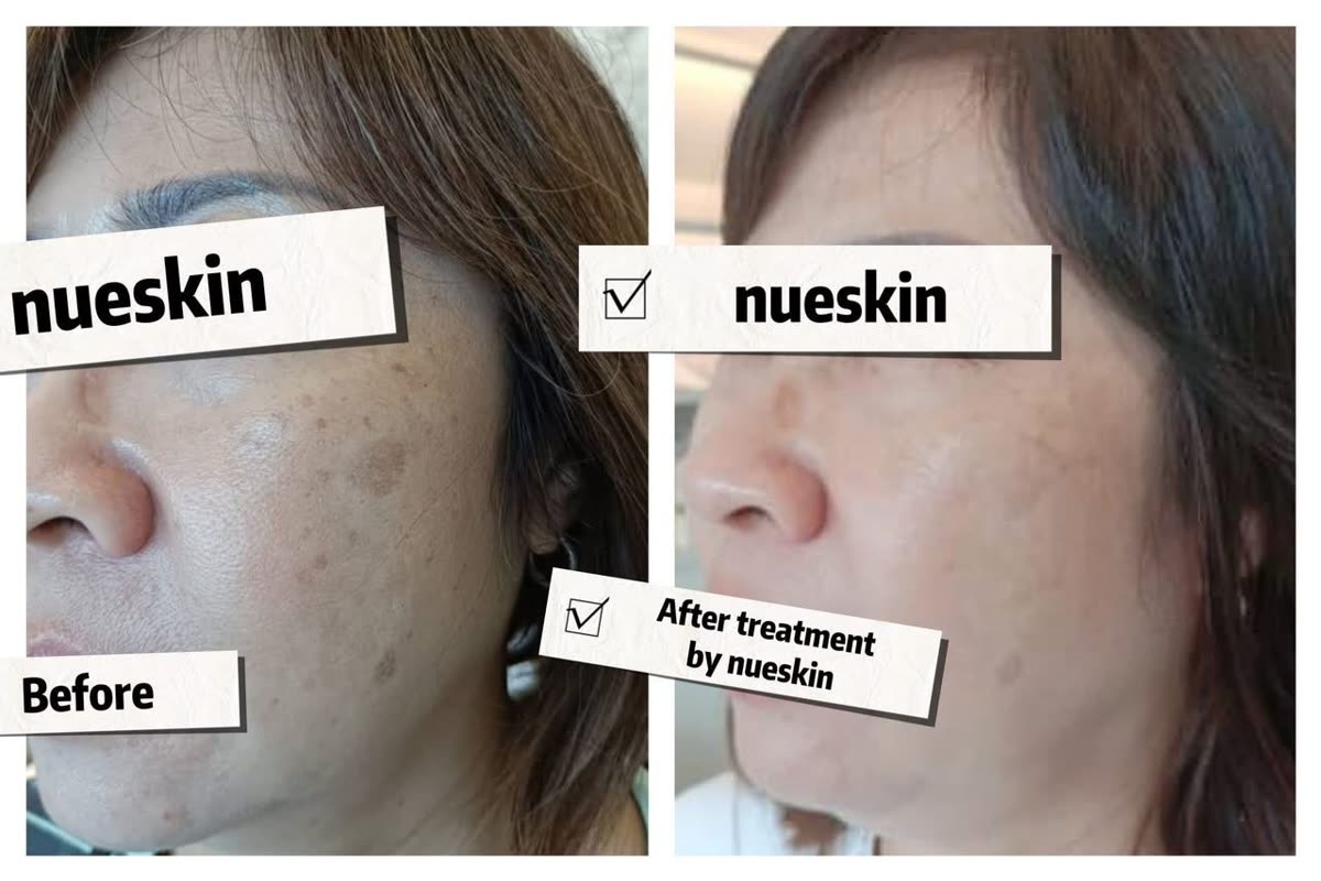 Cheek and jaw pigmentation spots treatment before and after — Nue Skin Beauty Esthetique