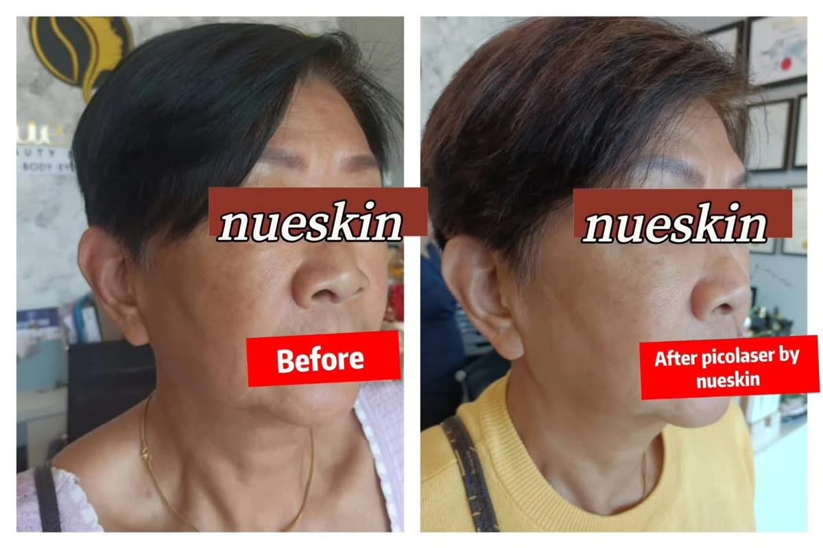 Cheek and jaw pigment spot pico laser treatment before and after — Nue Skin Beauty Esthetique