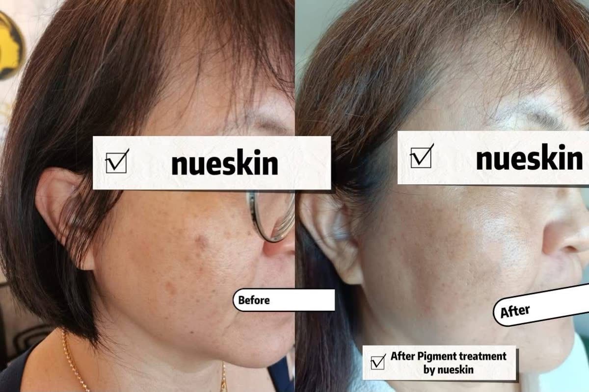 Pigment treatment jawline acne before and after — Nue Skin Beauty Esthetique