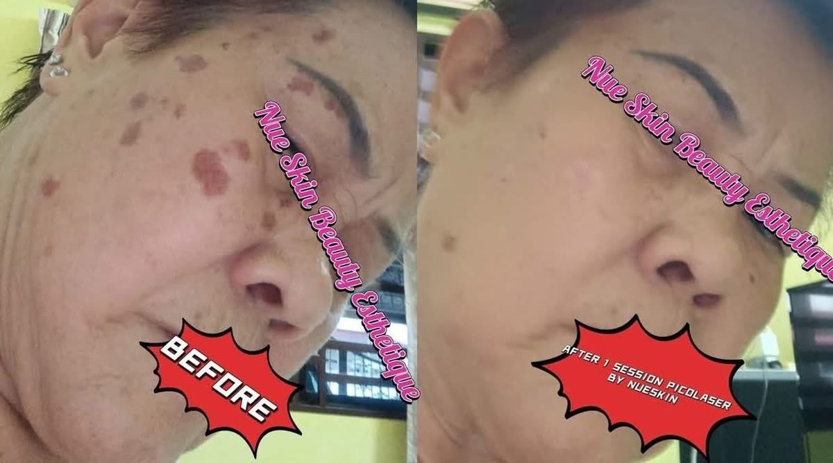 Pico laser pigmentation and age spot removal on cheek before and after — Nue Skin Beauty Esthetique