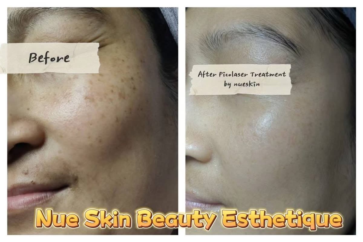 Pigment treatment acne scars full face before and after — Nue Skin Beauty Esthetique
