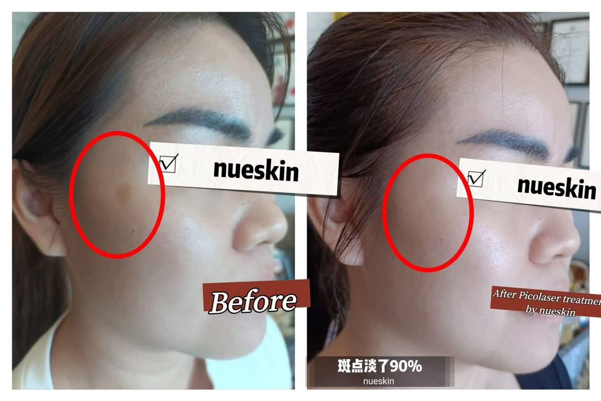 Temple pigment spot pico laser treatment before and after ninety percent fading — Nue Skin Beauty Esthetique