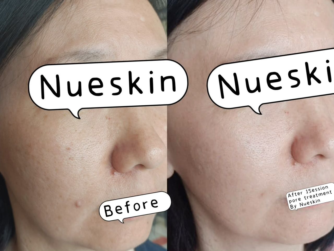Pore Refinement before and after — Nue Skin Beauty Esthetique
