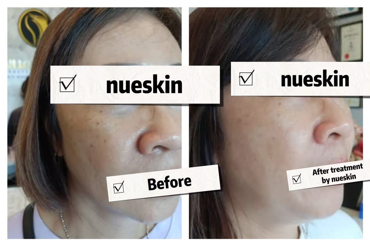 Enlarged pore refining on nose and cheek before and after — Nue Skin Beauty Esthetique