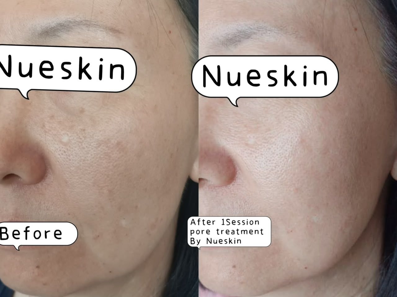 Pore Reduction Treatment before and after — Nue Skin Beauty Esthetique