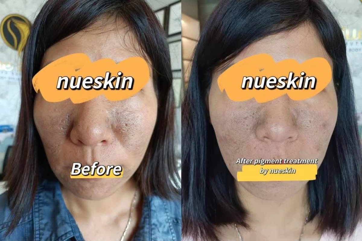 Full face acne scar and texture treatment before and after — Nue Skin Beauty Esthetique