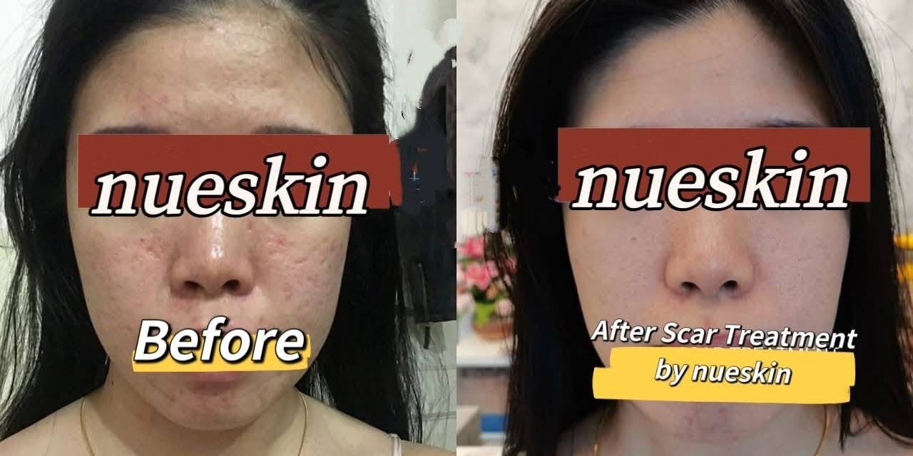 Acne Scar Treatment before and after — Nue Skin Beauty Esthetique